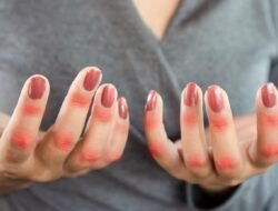 Flare Autoimun Tanpa Peringatan, Dokter Mayapada Hospital Selalu Siaga!