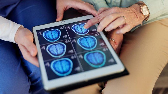 Kebiasaan yang Berkaitan dengan Risiko Perdarahan di Otak, Picu Stroke-Demensia - Update 1