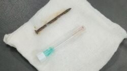 Tragedi Tak Terduga: Pria di Riau Tersedak Paku saat Perbaiki Kamar, Nyangkut di Paru-paru