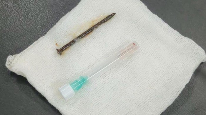 Tragedi Tak Terduga: Pria di Riau Tersedak Paku saat Perbaiki Kamar, Nyangkut di Paru-paru