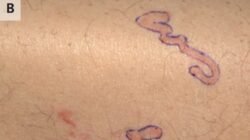 Pria Heran Ruam Kulitnya ‘Bergerak’, Rupanya Ada Cacing yang Merayap – Update 1