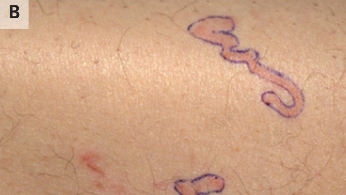 Pria Heran Ruam Kulitnya 'Bergerak', Rupanya Ada Cacing yang Merayap - Update 1