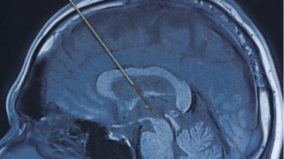 “Mengenal Deep Brain Stimulation: Solusi Revolusioner untuk Parkinson yang Mungkin Anda Tidak Ketahui”