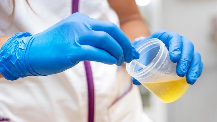 **Waspadai Warna Urine Seperti Ini Jadi Tanda ISK, Bisa Fatal Jika Tak Ditangani**