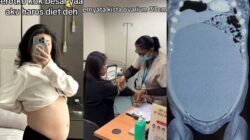 “Perut Buncit Tanda Kista? Dokter Spesialis Obgyn Di Surabaya Ungkap Kejutan untuk Wanita”